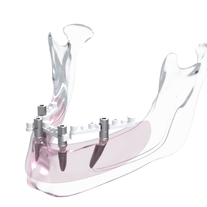 MedentiWings for Enhanced Edentulous Scanning Medentika®